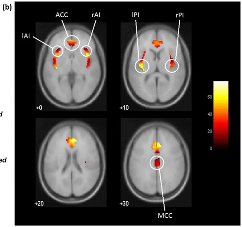 fMRI brain activation maps showing the empathy-for-pain network across four axial slices