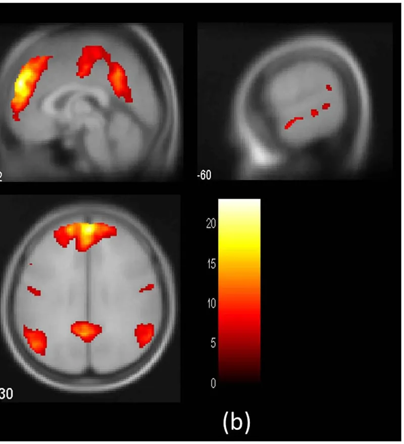 fMRI activation maps of the Theory of Mind network including temporoparietal junction and medial prefrontal cortex