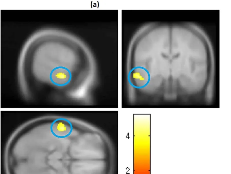 Voxel-based morphometry results highlighting grey matter volume differences in the left anterior superior temporal sulcus